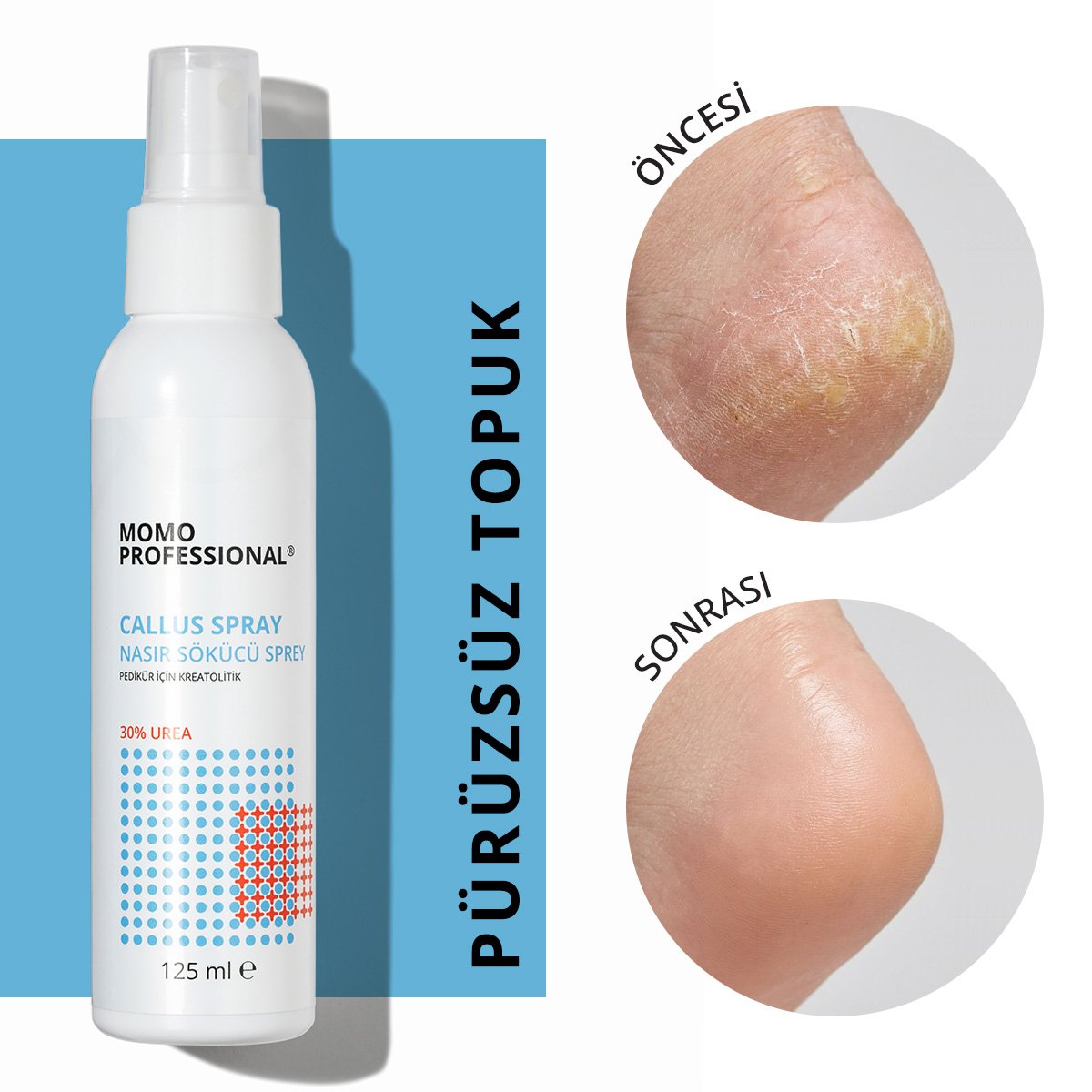 CallusSpray01-2 Momo Professional Callus Spray Pedikür Solüsyon Sprey - 10 ml - Görsel 1